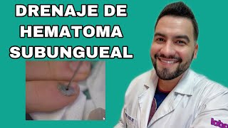 DRENAJE DE HEMATOMA SUBUNGEAL  DR DAVID CAMPOS [upl. by Naenaj]