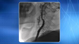 Chapter 12 TRA for addressing Internal Carotid Artery Stenting [upl. by Notterb350]