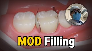 Dental Filling Procedure  MOD Molar Composite Restoration [upl. by Burn]