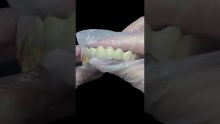 Porcelain Fused to Metal PFM Dental Bridge dentist dentallab dentalclinic smilemakeover [upl. by Yelrebma]