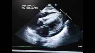 Echocardiography Essentials Detecting pericardial effusions [upl. by Trimmer]