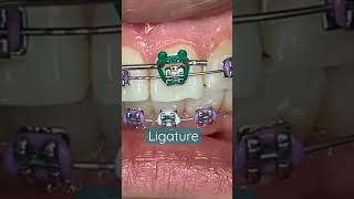 How ligature put on the BracketEasyway to Put ligature on bracketOrthodontic Treatment🦷 [upl. by Anatnom]