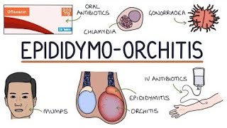 EpididymoOrchitis  epididymis [upl. by Suirradal]