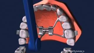 Advanced Orthodontics  Expanders [upl. by Attenehs]