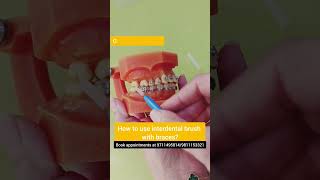 LIVE DEMO How to use interdental brush with braces Dr Srishti Bhatia braces [upl. by Aiksas746]