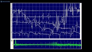 Kimura amp Kohara F22 Myotonic and spontaneous single muscle fiber discharges [upl. by Cate687]