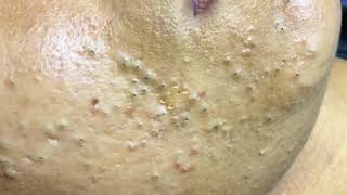 sac be spa blackheads elderly 2024 sacbe spa old age blackheads 2024 [upl. by Serica]