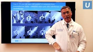 Treatment of Painful Spinal Metastases with Radiofrequency Energy  UCLAMDChat [upl. by Rj]