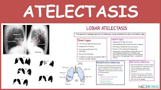 Atelectasis Types Pathophysiology and XRAY Findings Simplified [upl. by Hako]