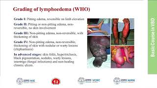 31Filariasis Clinical Features Diagnosis and Management [upl. by Euqirat535]