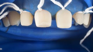 Ceramic Veneer Cementation  Porcelain Laminates Bonding  Adhesive Cementation [upl. by Nawad]