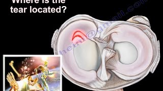 Knee Pain  Meniscus tear  Everything You Need To Know  Dr Nabil Ebraheim [upl. by Illom56]