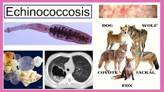 echinococcosis [upl. by Bill229]