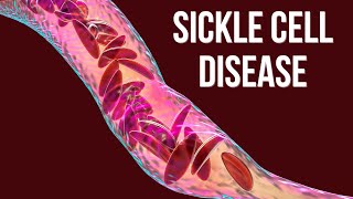 Sickle Cell Disease Causes pathophysiology amp Treatment clinical essential [upl. by Chesnut48]