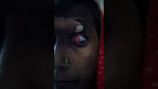 recorrent episcleritis from 2 years youtubeshorts shortvideo episcleritis eyedoctor doctor [upl. by Astera]