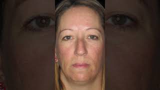 Amazing EYELID SURGERY Results Before amp After Blepharoplasty Photos blepharoplastysurgery [upl. by Annyl]