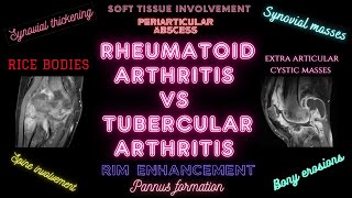 RHEUMATOID ARTHRITIS VS TUBERCULAR ARTHRITIS [upl. by Depoliti]