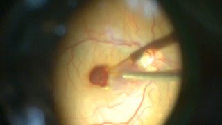 Displacement of subfoveal hemorrhage by perfluorocarbon subfoveal hemoraji yer değiştirilmesi [upl. by Floeter]