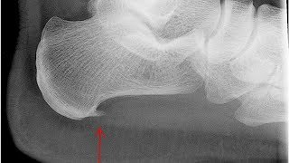 Comment guérir une épine calcanéenne et soulager la douleur au talon [upl. by Sitoeht]