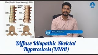 Diffuse Idiopathic Skeletal Hyperostosis DISH [upl. by Lekim]