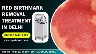 Red Birthmark Removal  Portwine Stain Removal in Delhi India by Pulsed Dye Laser  Dr PK Talwar [upl. by Josy170]