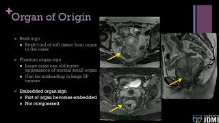 03 Approach to Peritoneal and Retroperitoneal Masses [upl. by Samaj]