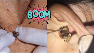 Satisfying Pimple Popping Ultimate Extraction Compilation 😱 [upl. by Luas]