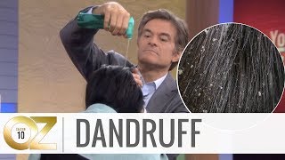 Quick and Easy Home Remedies For Dandruff [upl. by Nolaj]