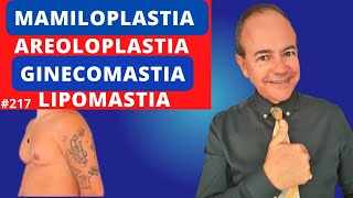 Ginecomastia Lipomastia Mamiloplastia Areoloplastia Dr Jacintho  Cirurgião Plástico [upl. by Tobiah]