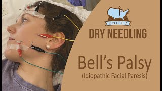 Treat Bells Palsy with Needles [upl. by Alfonse]