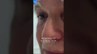 Removing Scleral Lenses [upl. by Dall577]