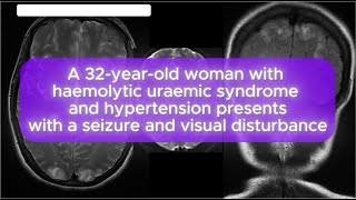 Case 123 A 32yearold woman with haemolytic uraemic syndrome and hypertension [upl. by Allene]