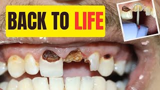 Need a Tooth Implant Alternative See How Dentist save teeth with Crown and Filling [upl. by Ciro]