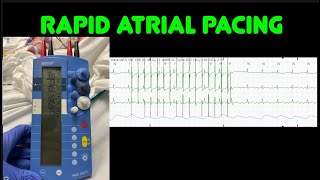 Rapid atrial pacing [upl. by Aidnyl]