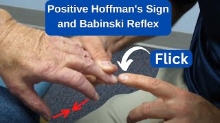 Positive Hoffmans Sign and Babinski Reflex in an MS Patient [upl. by Lammaj]