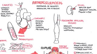 Atherosclerosis  Pathophysiology [upl. by Hueston]