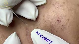 Loan Nguyen Acne Treatment 1689h [upl. by Selie]