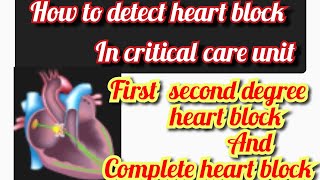 Heart block Atrioventricular block  AV block  ECG of heart block  mobitz type 1 and 2 [upl. by Ahtebat]