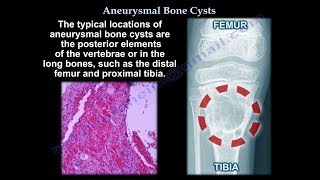 Aneurysmal Bone Cyst  Everything You Need To Know  Dr Nabil Ebraheim [upl. by Garrott]