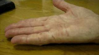 Dupuytrens Contracture Correction  6 Months Post Surgery [upl. by Suez]