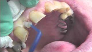 Mini Dental Implant for Replacement of Missing Tooth Maxillary Lateral Incisor [upl. by Laise560]