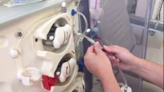 Dialysis twister measurement of arteriovenous fistula flow [upl. by Teddman]