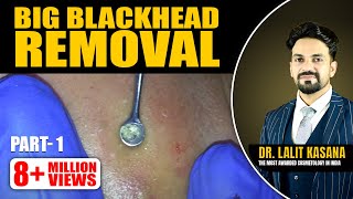 BIG BLACKHEAD REMOVAL Part 1 [upl. by Colpin688]