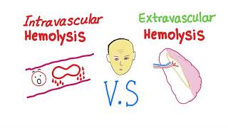 Intravascular Vs Extravascular Hemolytic Anemia Whats The ACTUAL Difference [upl. by Yadnil]