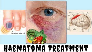 Types of Haematoma  Medical Treatment for a Hematoma  clickbank revirew [upl. by Florina984]