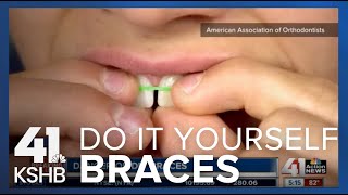 DIY Braces [upl. by Hutt]