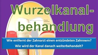 Wie verläuft eine Wurzelbehandlung [upl. by Greenman465]