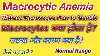 Macrocytic anemia  Microcytic anemia  Anemia in hindi [upl. by Coniah]