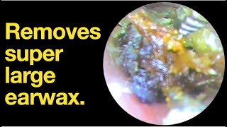 Removes super large earwax ear wax removal  ear cleaning  ASMR  relaxation  relax [upl. by Notliw]