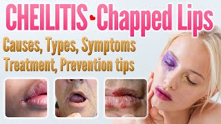 Cheilitis Causes Symptoms Types Risk Factors Treatment Prevention Home remedies  Chapped Lips [upl. by Hazard]